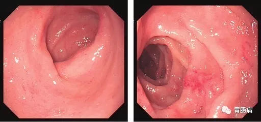 萎縮性胃炎不可怕，只要真正了解它