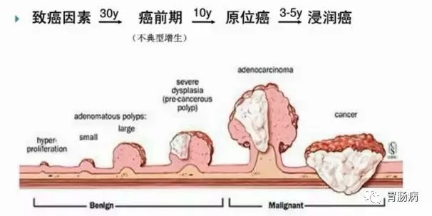 體檢查出腸息肉一定要切除！ 95%腸癌由它演變而來