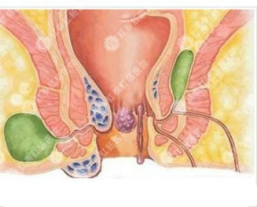 南寧哪個(gè)醫(yī)院可以做肛周膿腫？